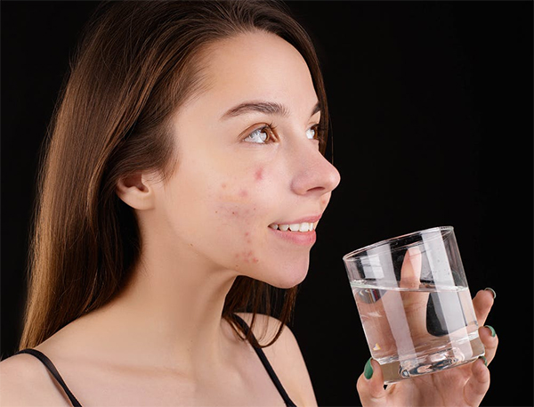 dry skin and acne