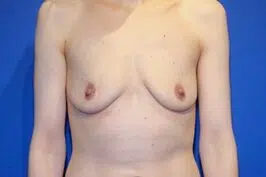 Before photo of woman